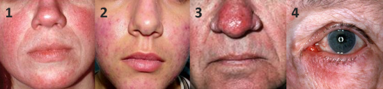 Rosacea types / rosacea subtypes / skincare concern / sensitive skin