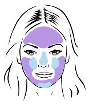 Areas commonly affected by adult acne. Purple - most common areas for breakouts (pimples, etc). Blue - most common areas for blackheads