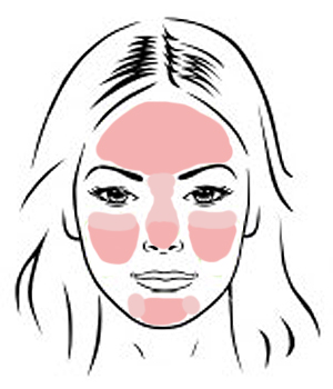 Where rosacea commonly shows up