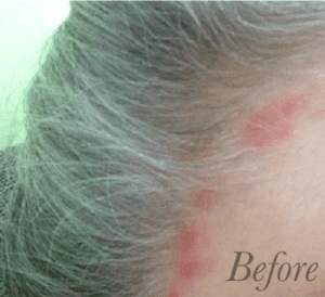 how to get rid of and clear up red bumps on forehead - including along the hairline (hair line eczema breakouts and acne)