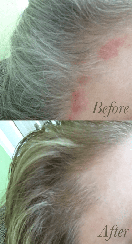 how to get rid of and clear up red bumps on forehead - including along the hairline (hair line eczema breakouts and acne)