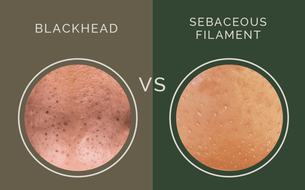 what blackheads look like / is this a blackhead / blackheads versus sebaceous filament, what's the difference? congestion / clogged pores / 