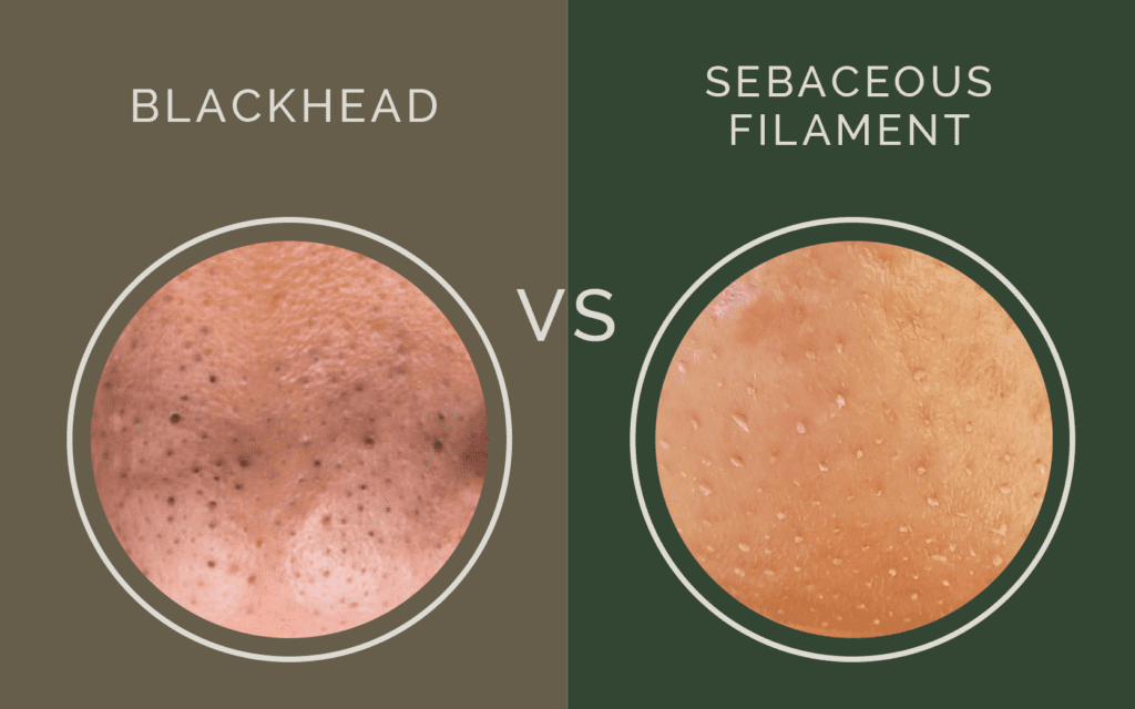 clogged pores vs blackheads