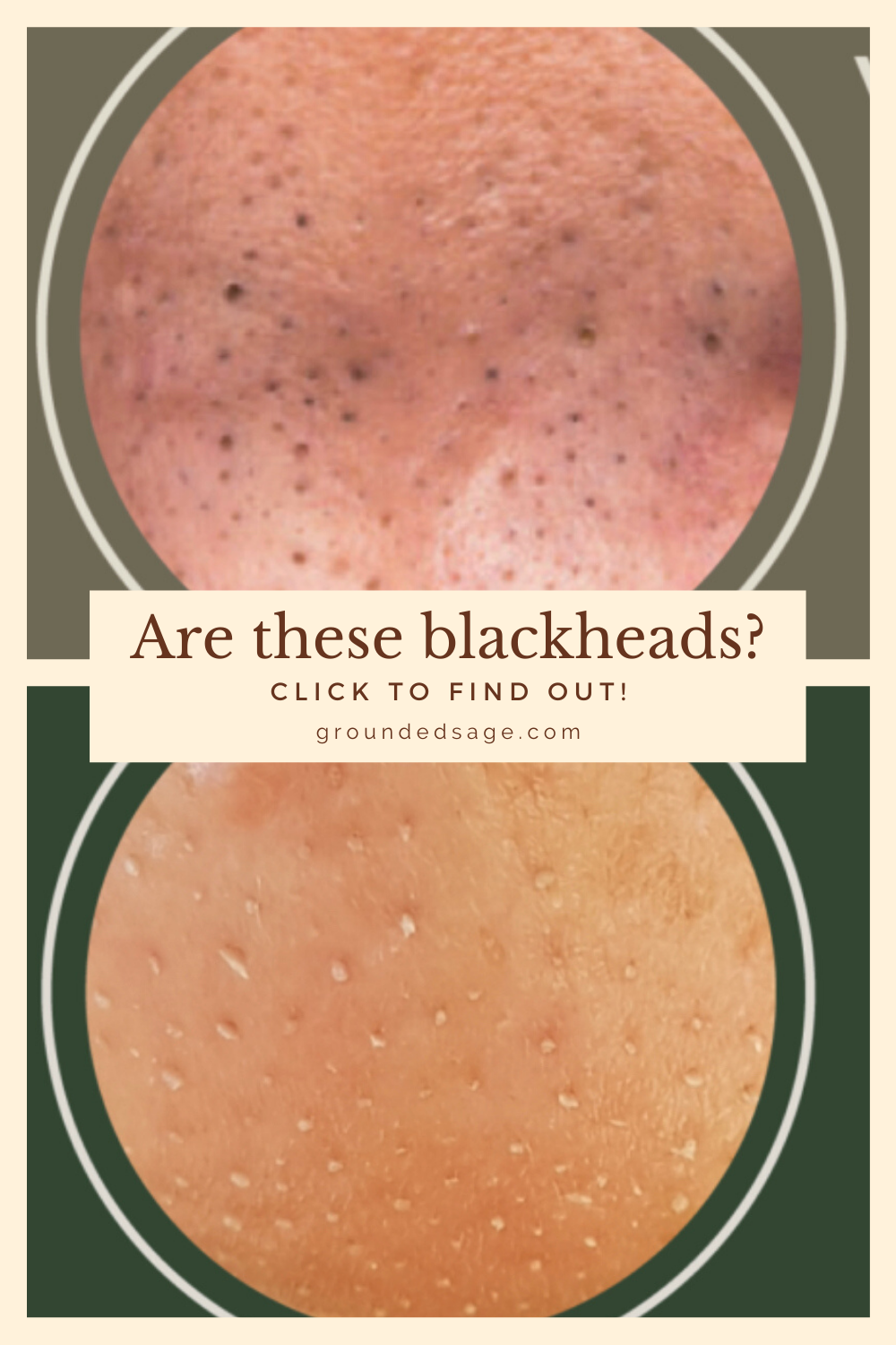 What does a blackhead look like? Pictures of blackheads and what the differences is between a blackhead and sebaceous filament on nose or chin. 