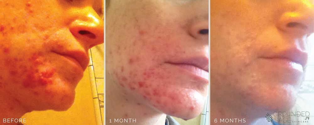 Amy's acne journey // before and after photos with Grounded Sage Skincare