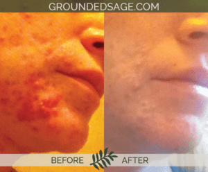 amy's before and after story / acne journey / green beauty skincare / eco skincare