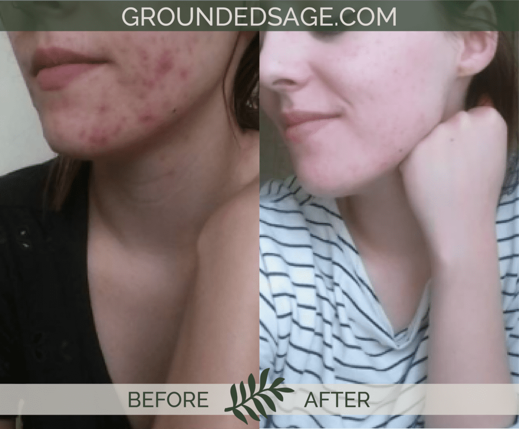 Heather's before & after story / acne / green beauty / skincare / eco beauty