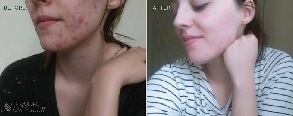 Heather's before and after photos // acne healing with Grounded Sage Skincare