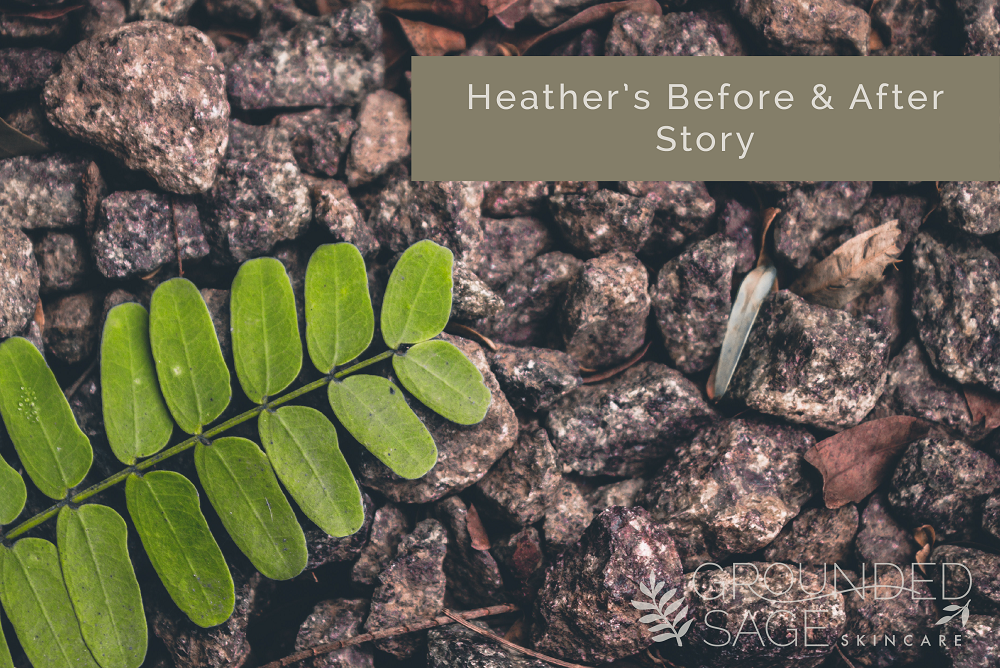 Heather's before and after story // body acne // green beauty