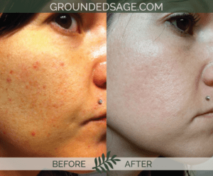 Jamie's before & after story / acne / green beauty / skincare / eco beauty