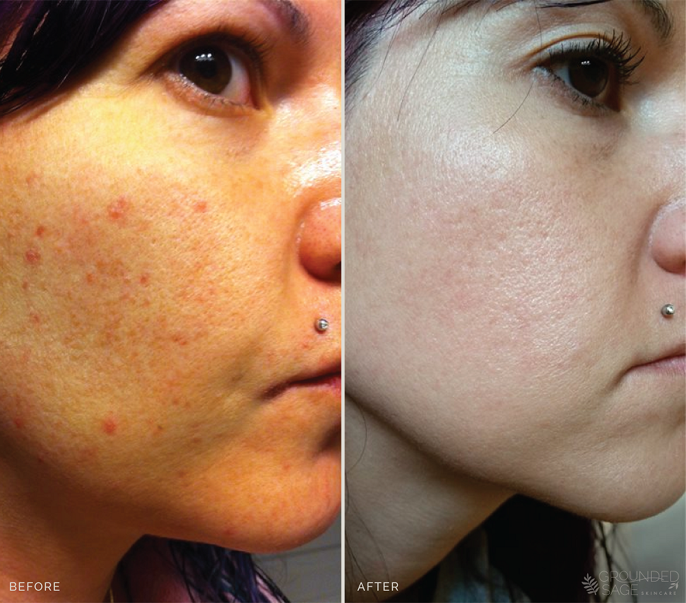 Jamie's before and after photos // skincare // green beauty