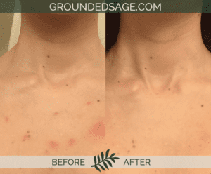 Jana's before & after story / acne / green beauty / skincare / eco beauty