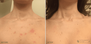 Jana's before and after photos // acne healing with grounded sage skincare