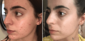 jaye's before and after photos / acne journey