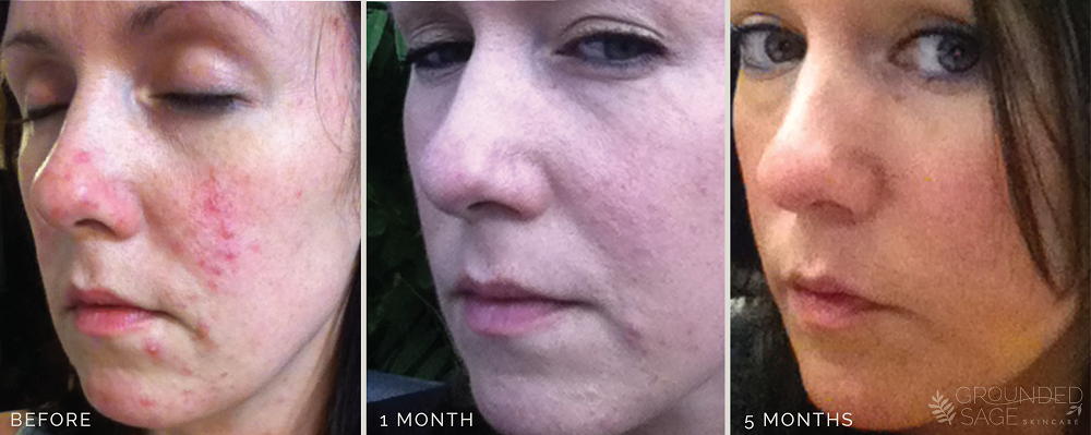 Kat's before and after photos // acne healing with Grounded Sage Skincare