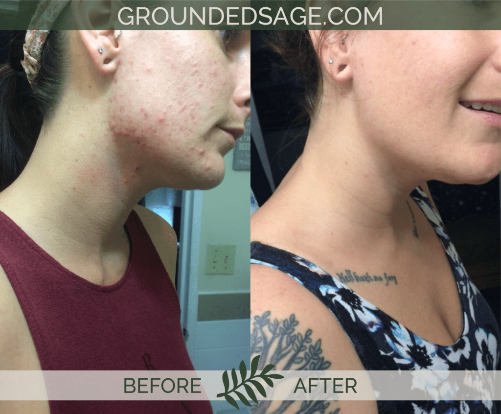 Kathleen's before & after story / acne / green beauty / skincare / eco beauty