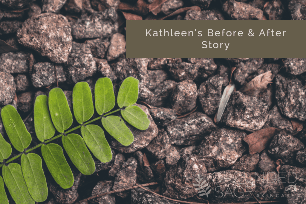 Kathleen's before and after story // acne journey with Grounded Sage Skincare