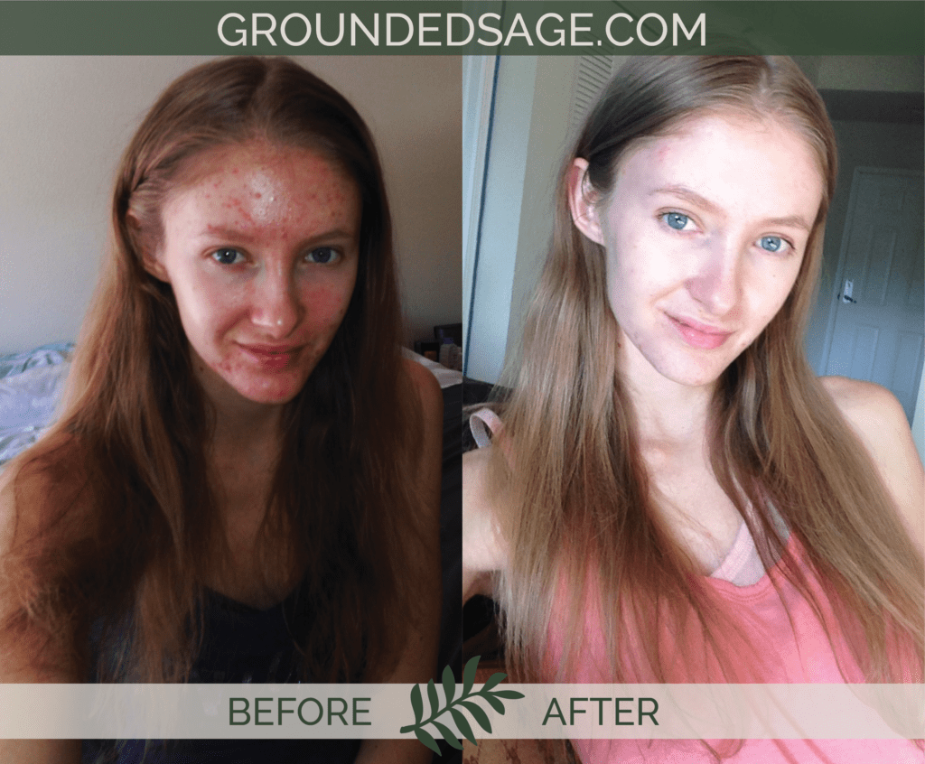 Katrina's before & after story / acne / green beauty / skincare / eco beauty