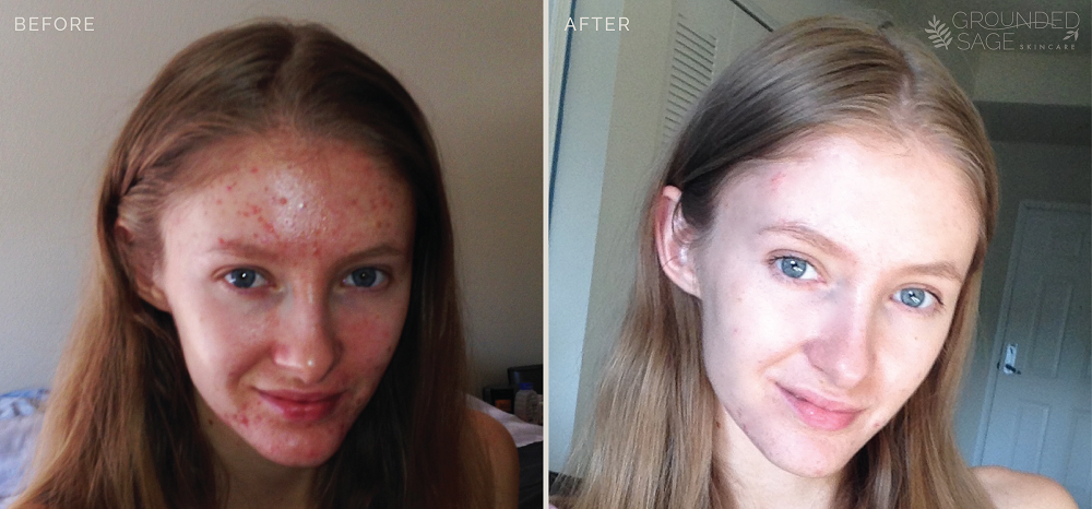 Katrina's before and after photos // acne healing // grounded sage skincare