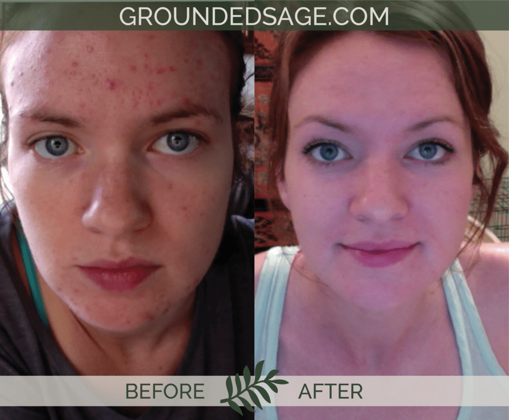 Khyber's before & after story / acne / green beauty / skincare / eco beauty