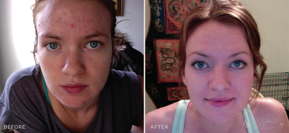 Khyber's before and after photos // acne healing with Grounded Sage Skincare