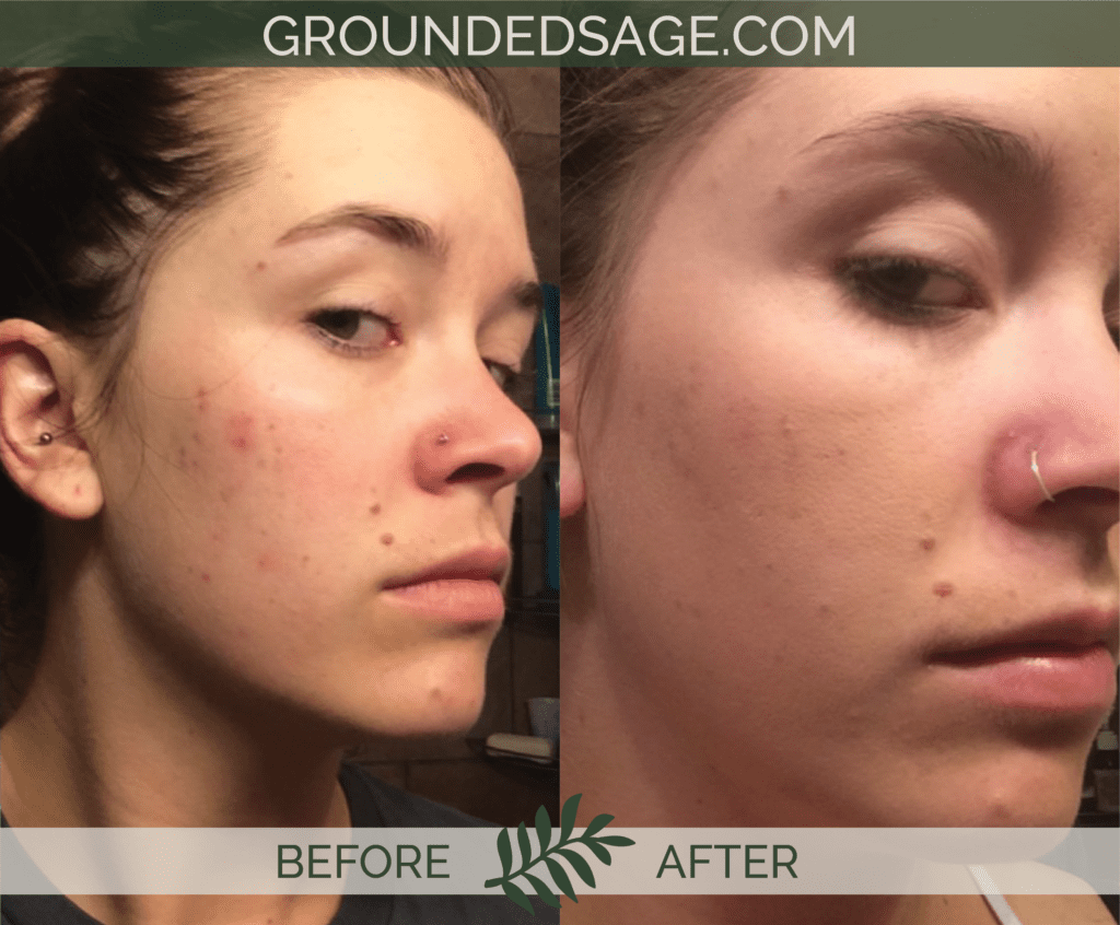 Leanna's before & after story / acne / green beauty / skincare / eco beauty