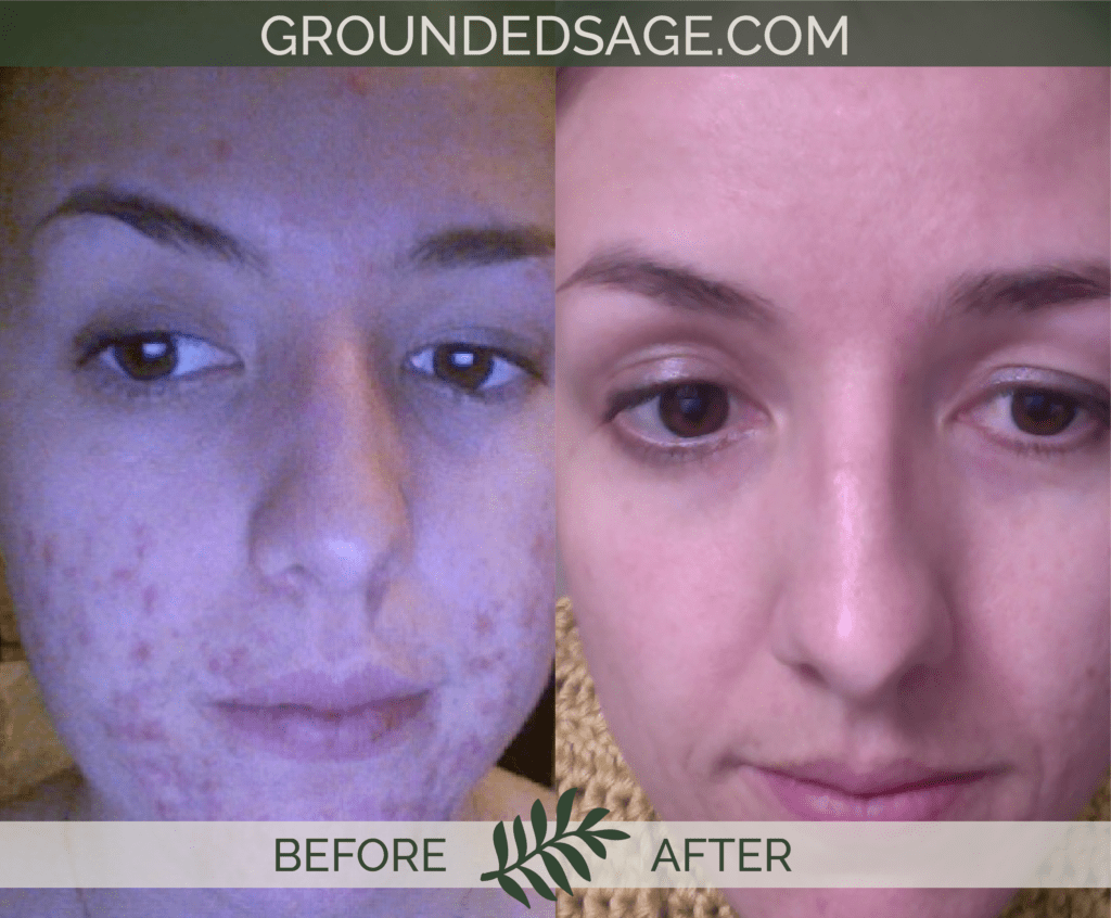 Melissa's before & after story / acne / green beauty / skincare / eco beauty