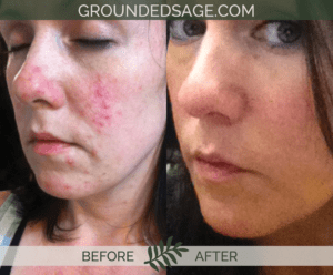 Kat's before & after story / acne / green beauty / skincare / eco beauty