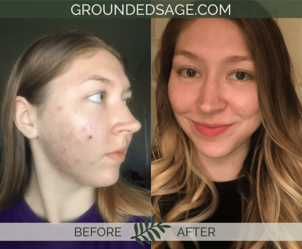 Shyenne's before and after story with Grounded Sage Skincare / acne / green beauty / skincare for acne