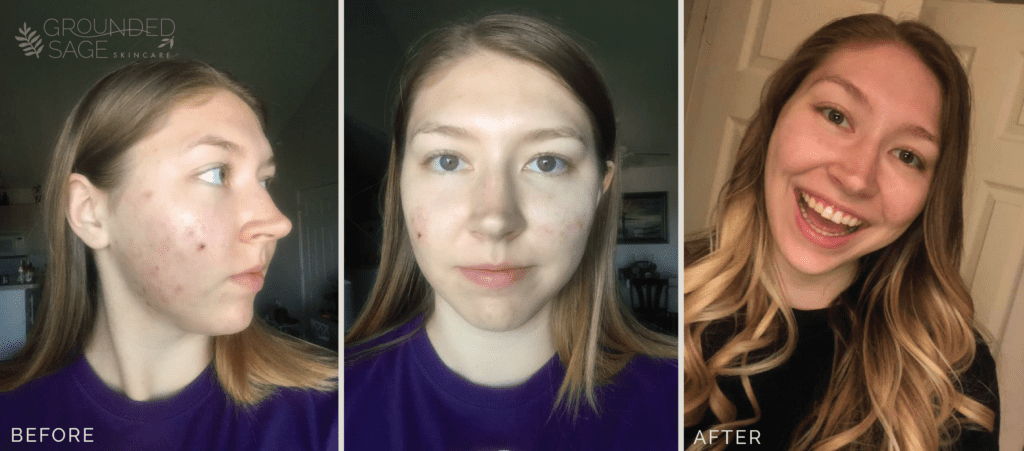 Shyenne's before and after story with Grounded Sage Skincare / acne / green beauty / skincare for acne