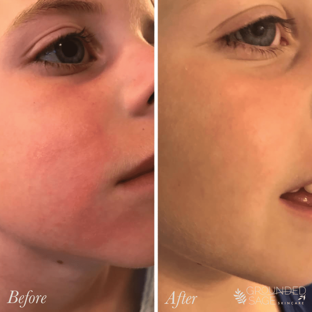 a young boy's before and after story // skincare journey // green beauty