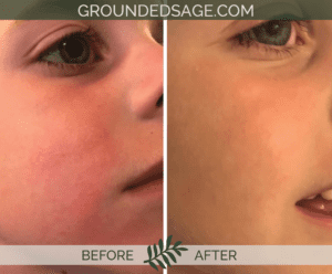 a young boy's before and after story // skincare journey // green beauty