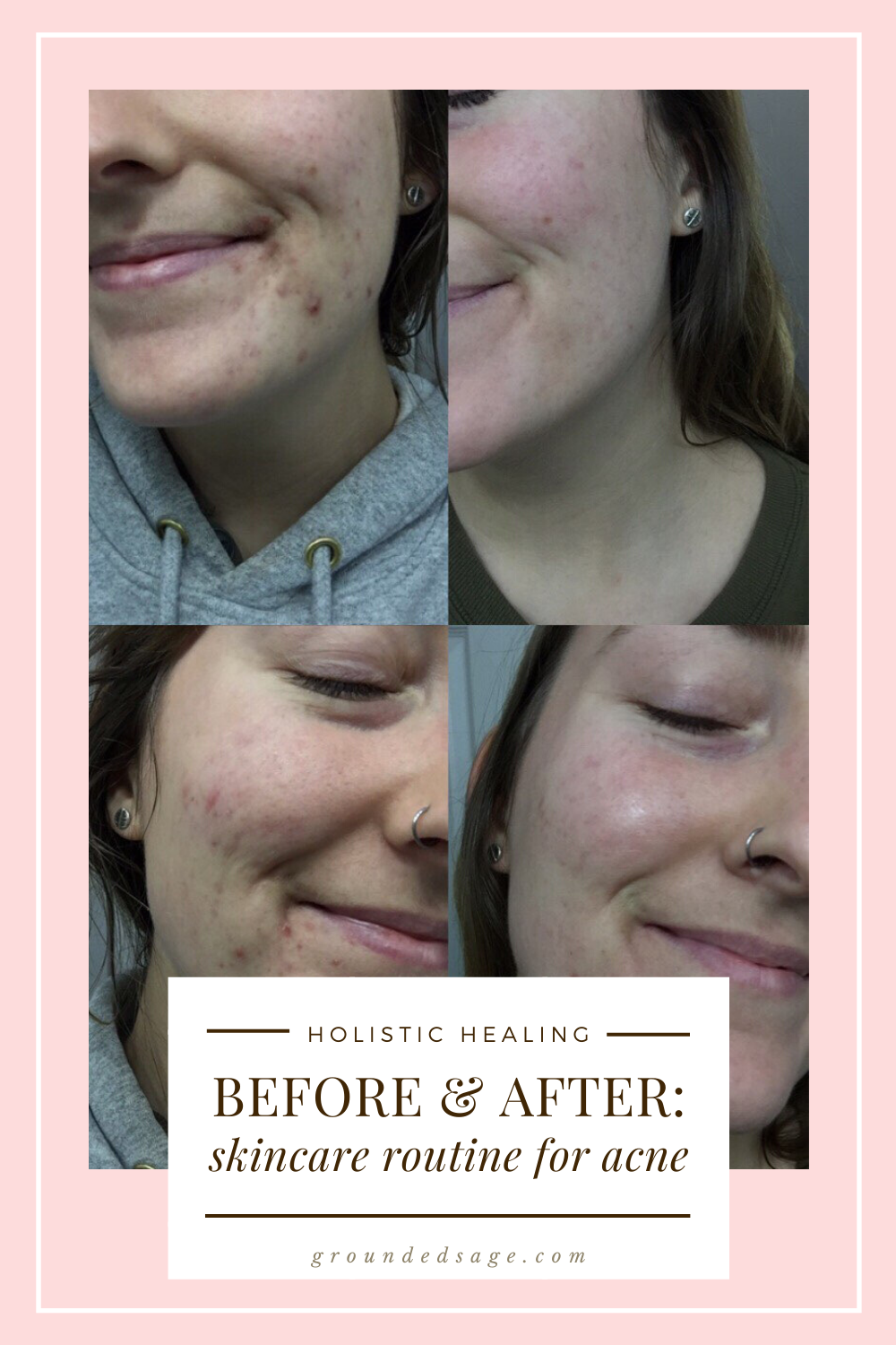 Skin Before and After Acne Skincare Routine with Vitamin C Serum