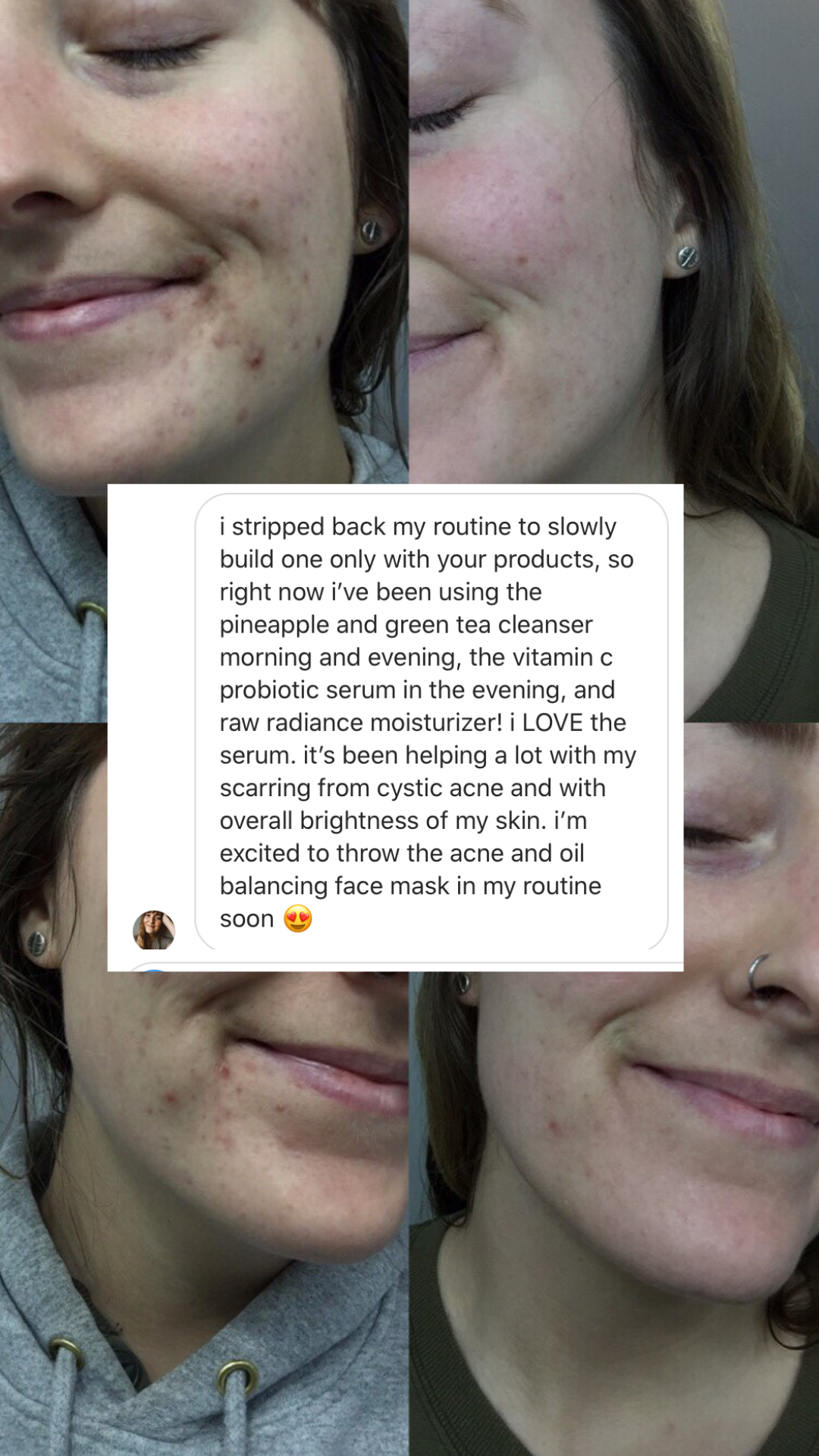 before and after skincare routine for acne