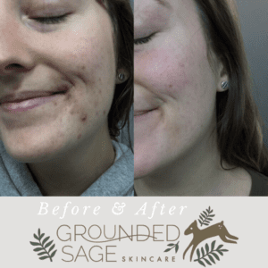 acne before and after pictures with the skincare routine used to clear up acne
