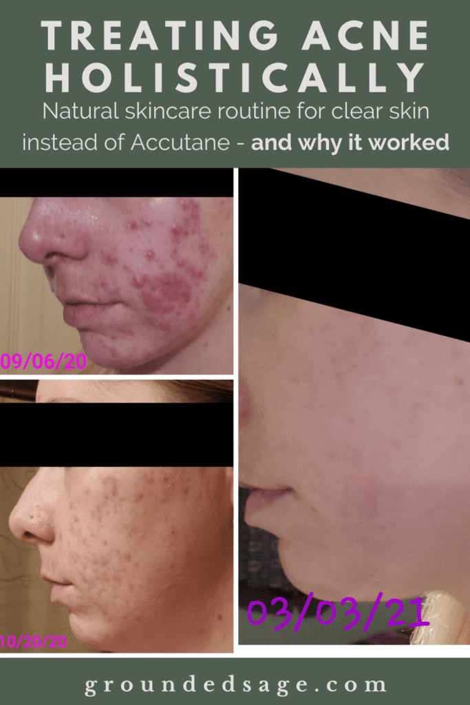 How I Cleared My Acne Blog - Treating Acne Holistically Instead of Accutane - My Acne Journey Blog and the complete step by step routine in my skin care routine for stubborn acne